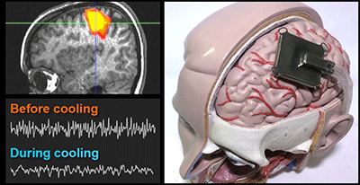 Simulating effects of focal brain cooling against epilepsy