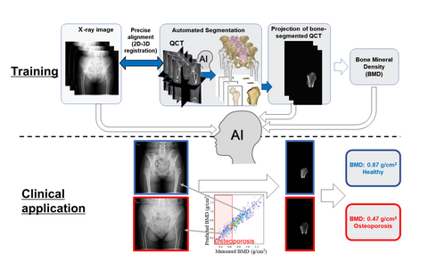 AI-based tool efficiently estimates bone mineral density from X-ray images